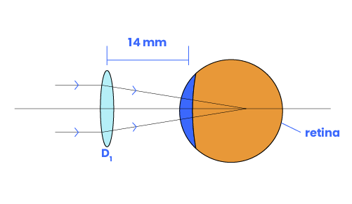Eyeglass moved a distance away from the eye refracts the image before the retina.