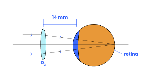 A vertex compensated lens focuses the image onto the retina.