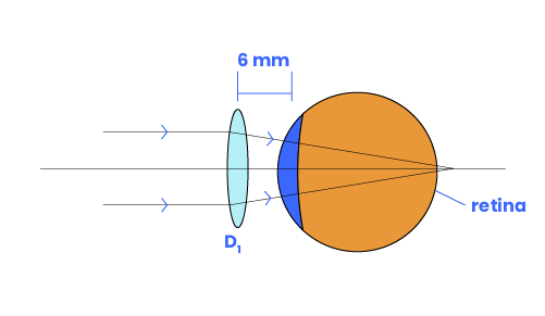 Eyeglass moved a distance towards from the eye refracts the image beyond the retina.