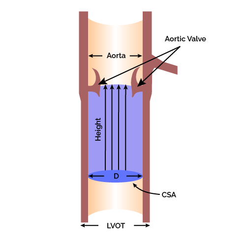 LVOT visualized as a cylinder