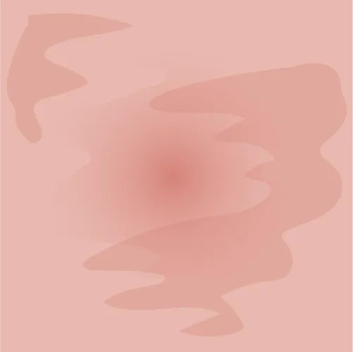 Example of eczema redness given the intensity score 2