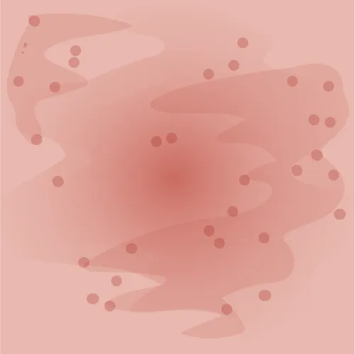 Example of eczema redness given the intensity score 3
