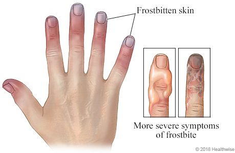 frostbite