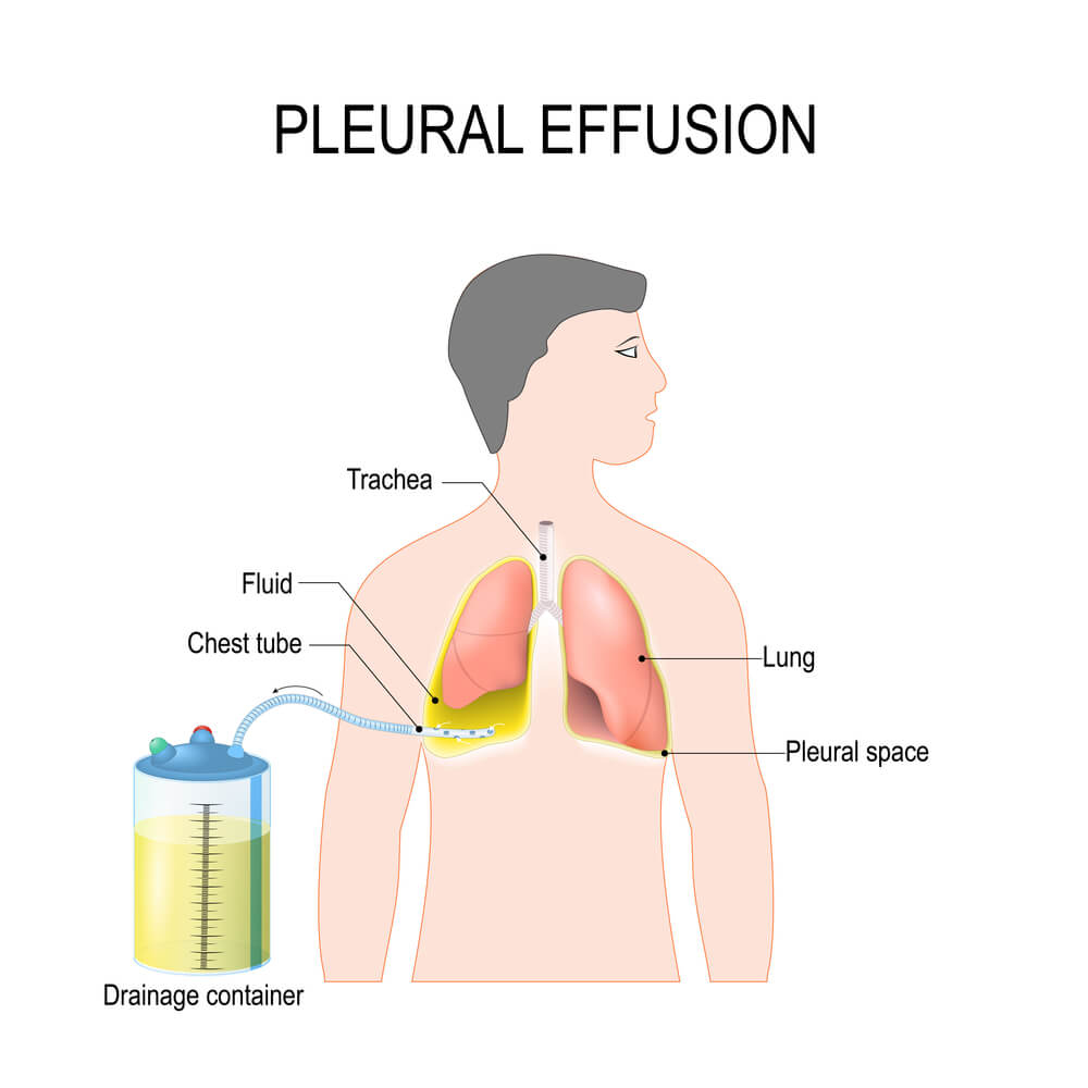 A scheme of pleural drainage.